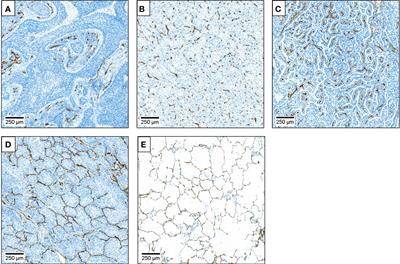 Impact of microvessel patterns and immune status in NSCLC: a non-angiogenic vasculature is an independent negative prognostic factor in lung adenocarcinoma